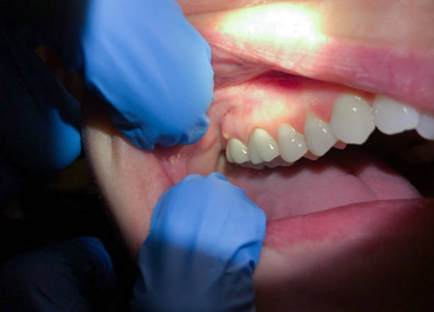 Best Knocked-Out Tooth Emergency  in Fairfield University, CT